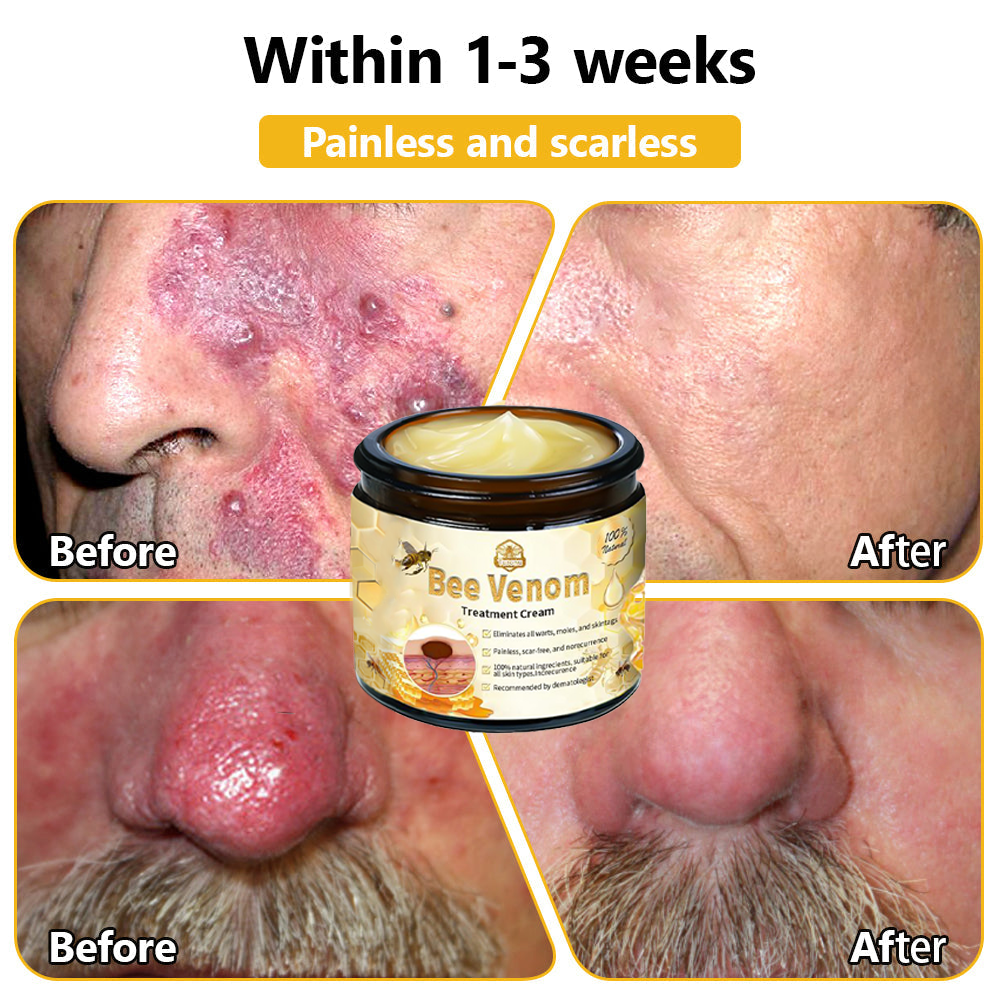 𝗧𝗟𝗢𝗣𝗔® Bee Venom Skin Treatment Cream (FDA Approved👨⚕️)💖