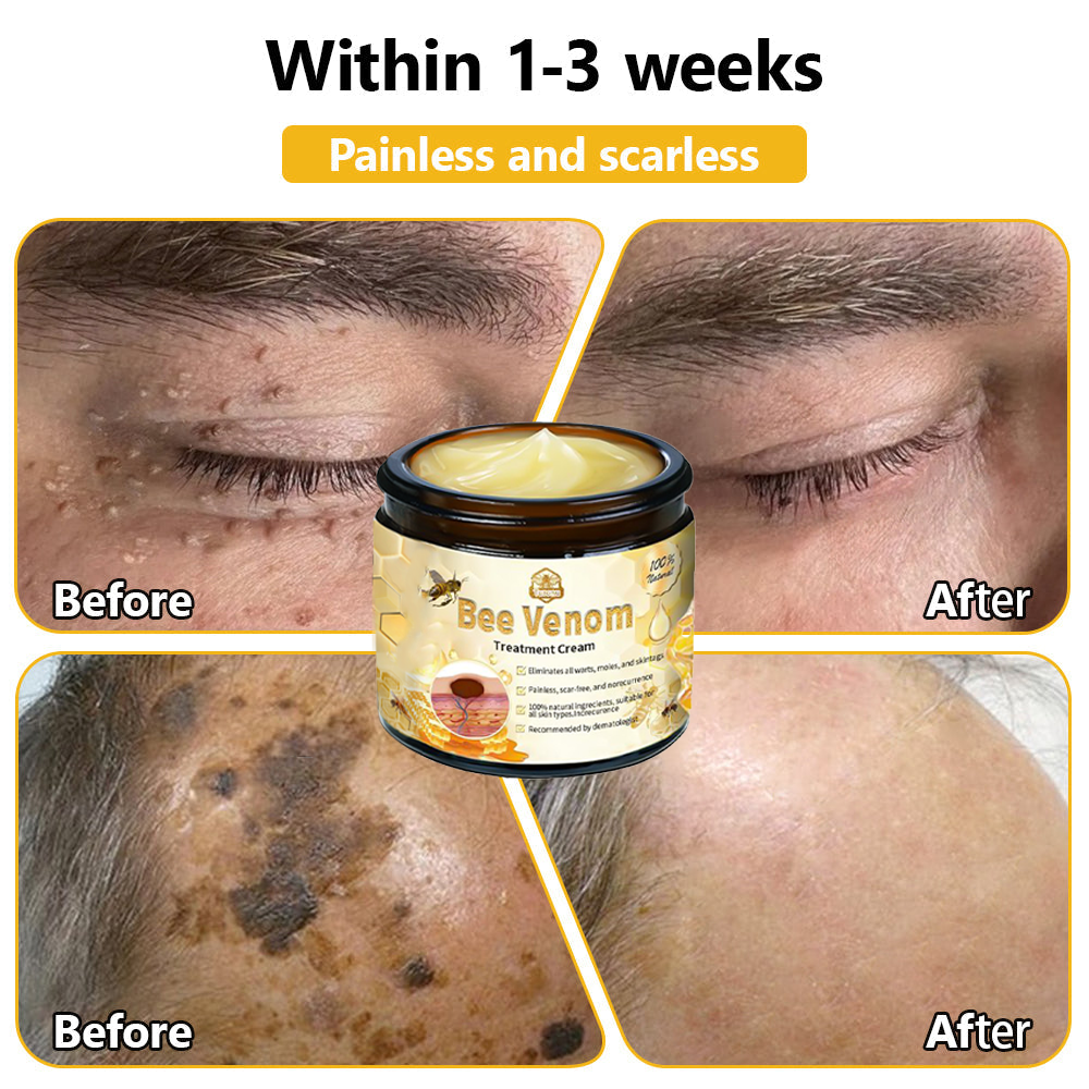 𝗧𝗟𝗢𝗣𝗔® Bee Venom Skin Treatment Cream (FDA Approved👨⚕️)💖