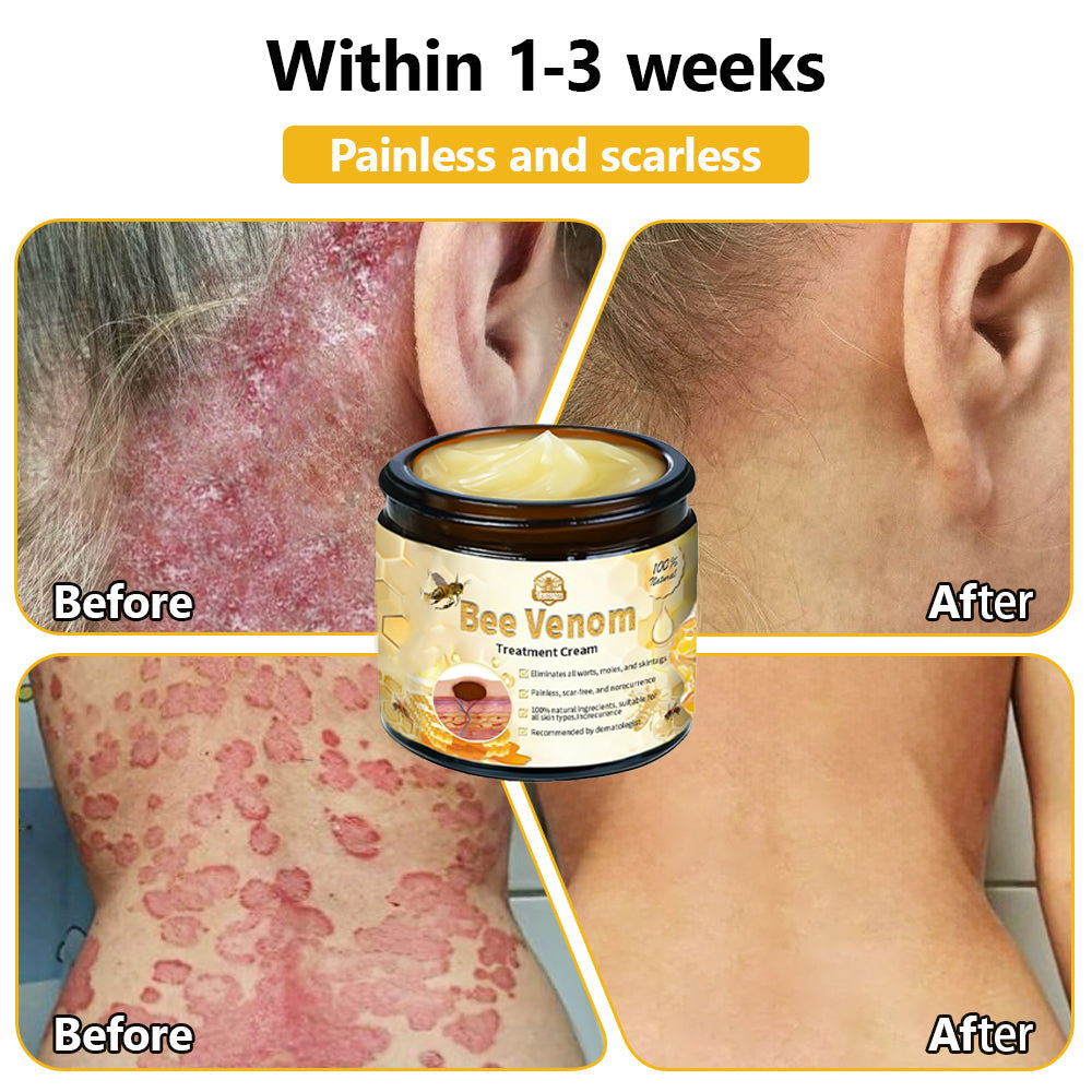 𝗧𝗟𝗢𝗣𝗔® Bee Venom Skin Treatment Cream (FDA Approved👨⚕️)💖