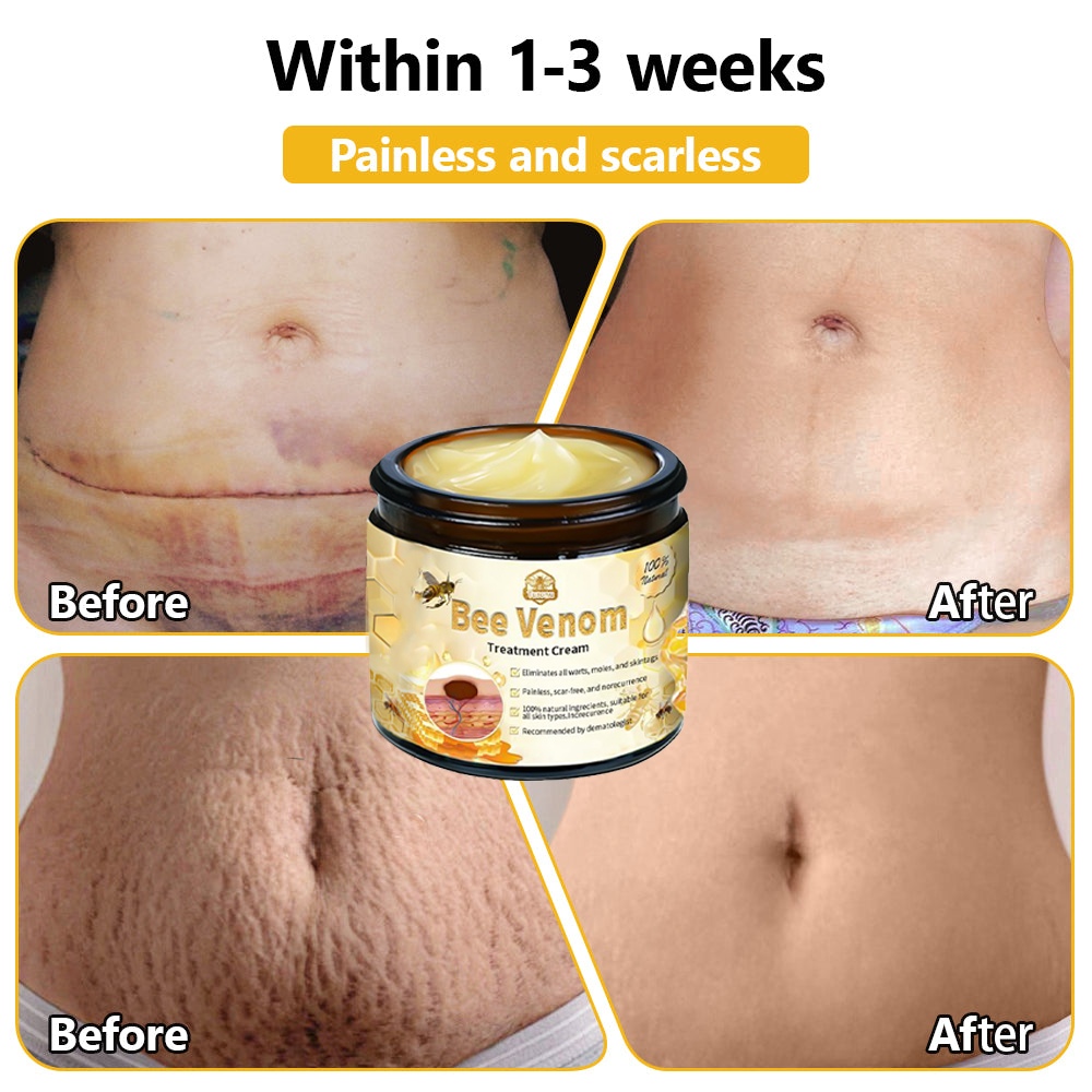 𝗧𝗟𝗢𝗣𝗔® Bee Venom Skin Treatment Cream (FDA Approved👨⚕️)💖