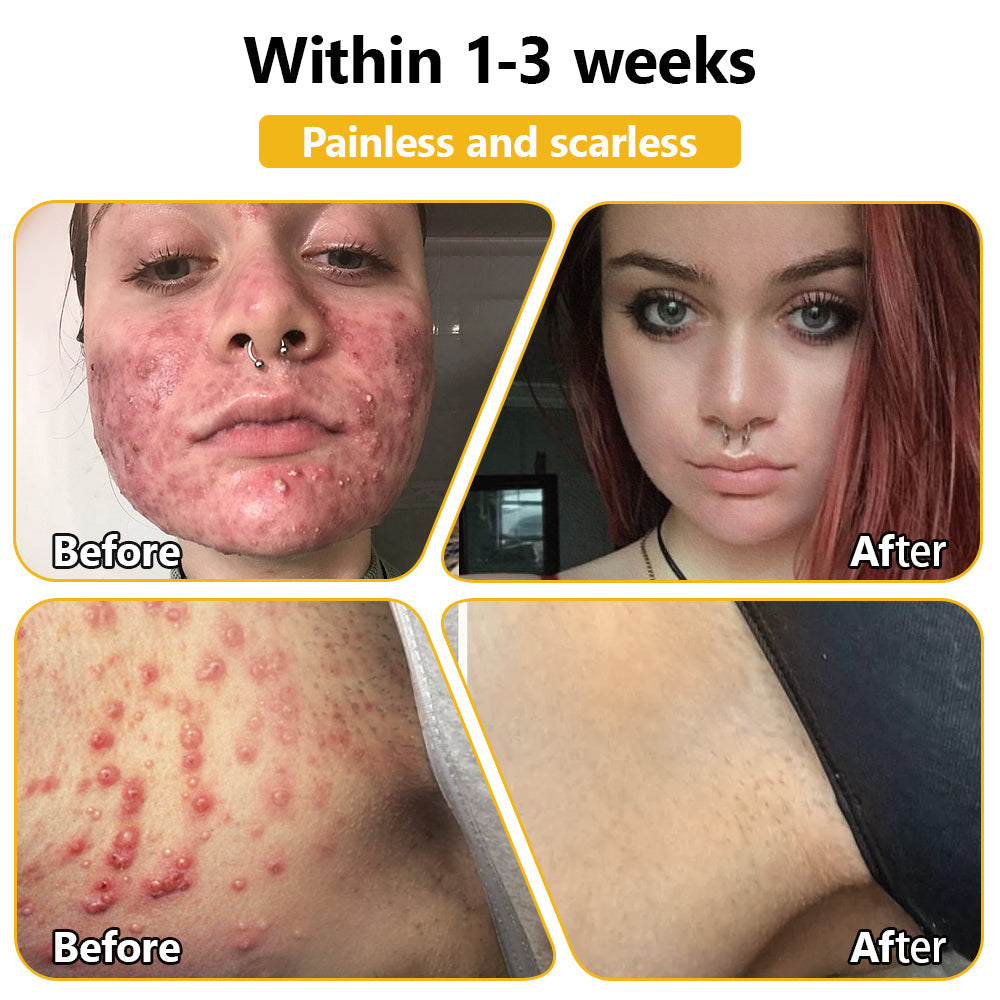 𝗧𝗟𝗢𝗣𝗔® Bee Venom Skin Treatment Cream (FDA Approved👨⚕️)💖