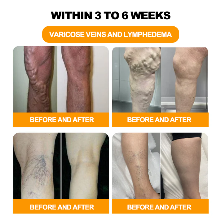 Cvreoz™ 30 žolelių lieknėjimo ir detoksikacijos pėdų vonios karoliukai-🦵👩⚕️(LANA sertifikavimas, Amerikos limfologų asociacija)