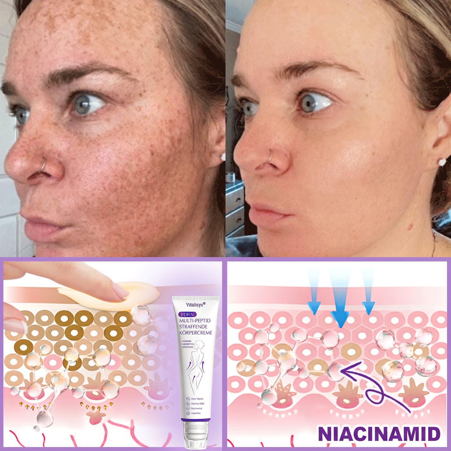 Offizieller Store✅: Vitalisys® PDRN Körpercreme mit Roller ✨ – Anti-Aging, Feuchtigkeitspflege, Hautstraffung, Lifting & Regeneration. Für ebenmäßigen Teint, Behandlung von Akne & Pigmentflecken, Warzen 🥇