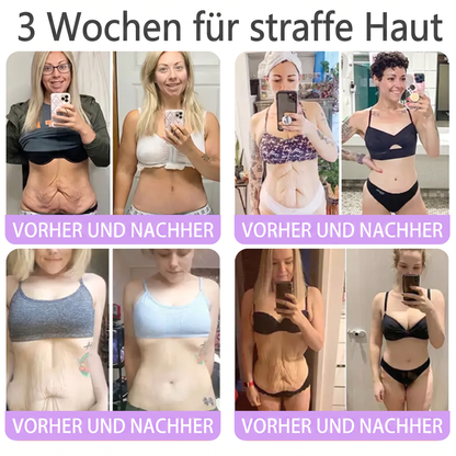 Offizieller Store✅: Vitalisys® PDRN Körpercreme mit Roller ✨ – Anti-Aging, Feuchtigkeitspflege, Hautstraffung, Lifting & Regeneration. Für ebenmäßigen Teint, Behandlung von Akne & Pigmentflecken, Warzen 🥇