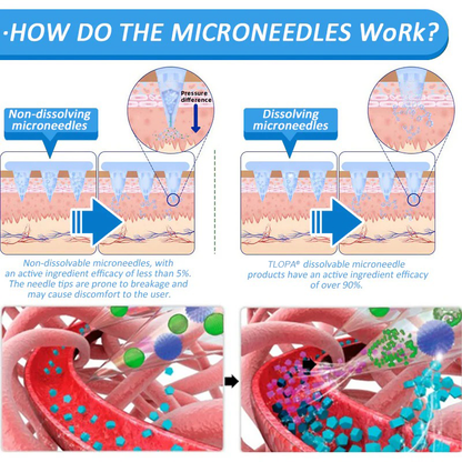 TLOPA® Nano Microneedle Patch with SMGT-GLP-1 & Matrixyl 3000 – Slimming,👨‍⚕️ Skin Tightening, Blood Sugar Support, No Injection, 7-Day Result