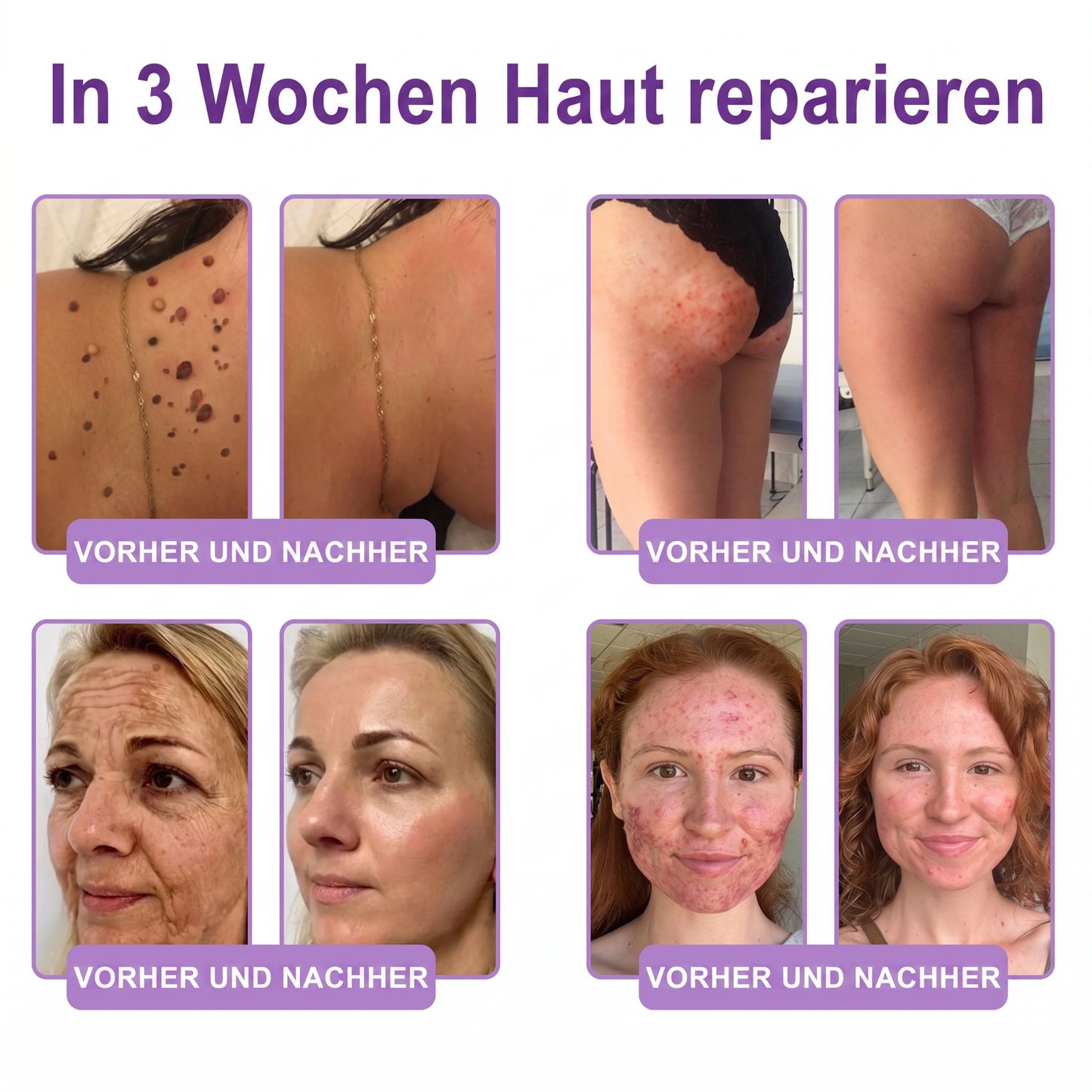 Offizieller Store✅: Vitalisys® PDRN Körpercreme mit Roller ✨ – Anti-Aging, Feuchtigkeitspflege, Hautstraffung, Lifting & Regeneration. Für ebenmäßigen Teint, Behandlung von Akne & Pigmentflecken, Warzen 🥇