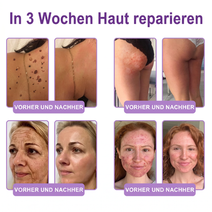 Offizieller Store✅: Vitalisys® PDRN Körpercreme mit Roller ✨ – Anti-Aging, Feuchtigkeitspflege, Hautstraffung, Lifting & Regeneration. Für ebenmäßigen Teint, Behandlung von Akne & Pigmentflecken, Warzen 🥇