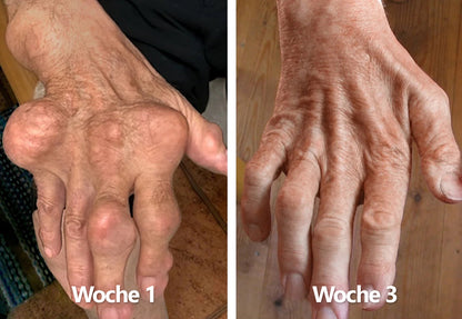 30% Rabatt 🎁🎁 | 𝐌𝐔𝐑𝐖𝐎𝐍® Bienengift-Salbe zur Schmerzlinderung & Knochenheilung ✨