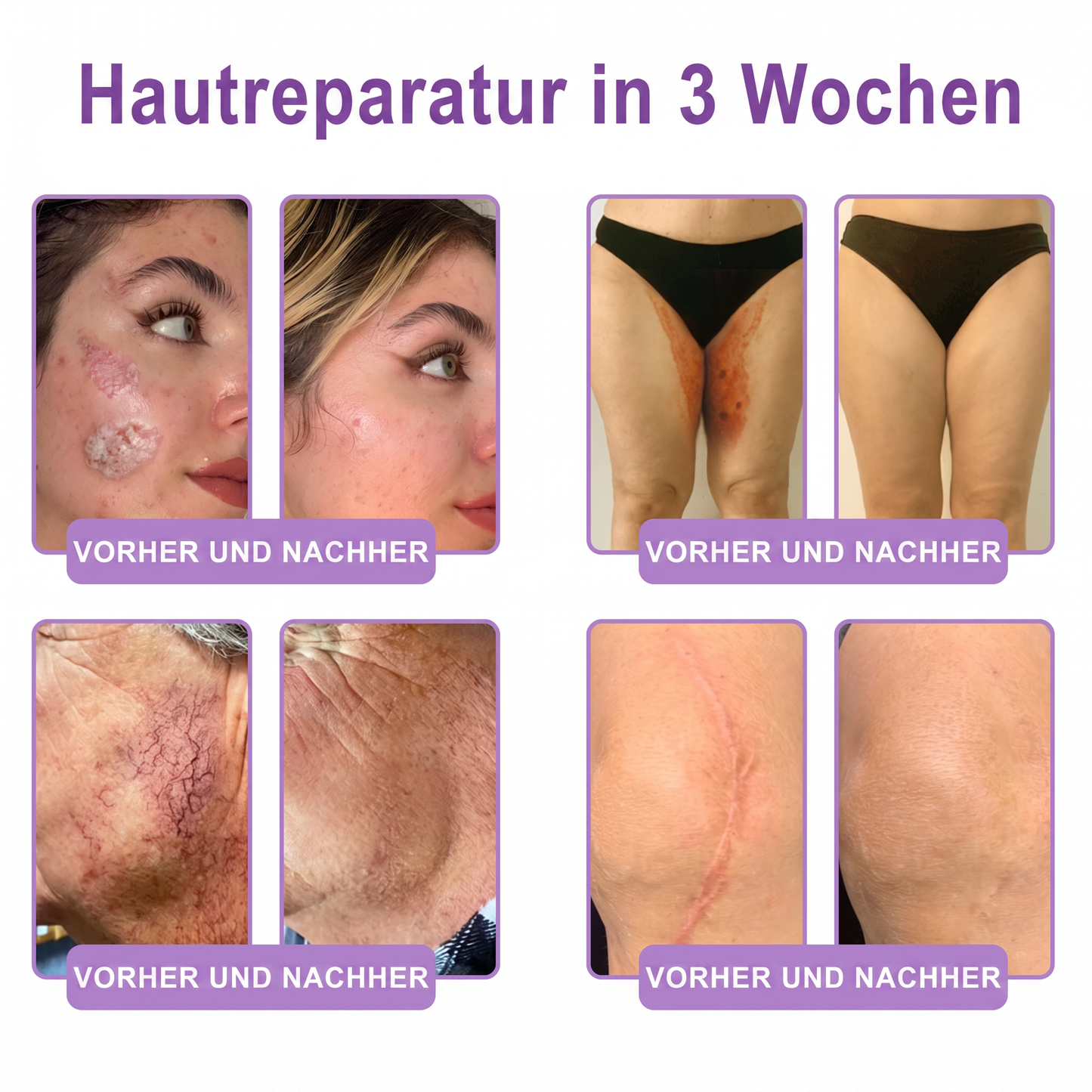 Offizieller Store✅: Vitalisys® PDRN Körpercreme mit Roller ✨ – Anti-Aging, Feuchtigkeitspflege, Hautstraffung, Lifting & Regeneration. Für ebenmäßigen Teint, Behandlung von Akne & Pigmentflecken, Warzen 🥇