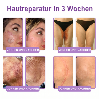 Offizieller Store✅: Vitalisys® PDRN Körpercreme mit Roller ✨ – Anti-Aging, Feuchtigkeitspflege, Hautstraffung, Lifting & Regeneration. Für ebenmäßigen Teint, Behandlung von Akne & Pigmentflecken, Warzen 🥇